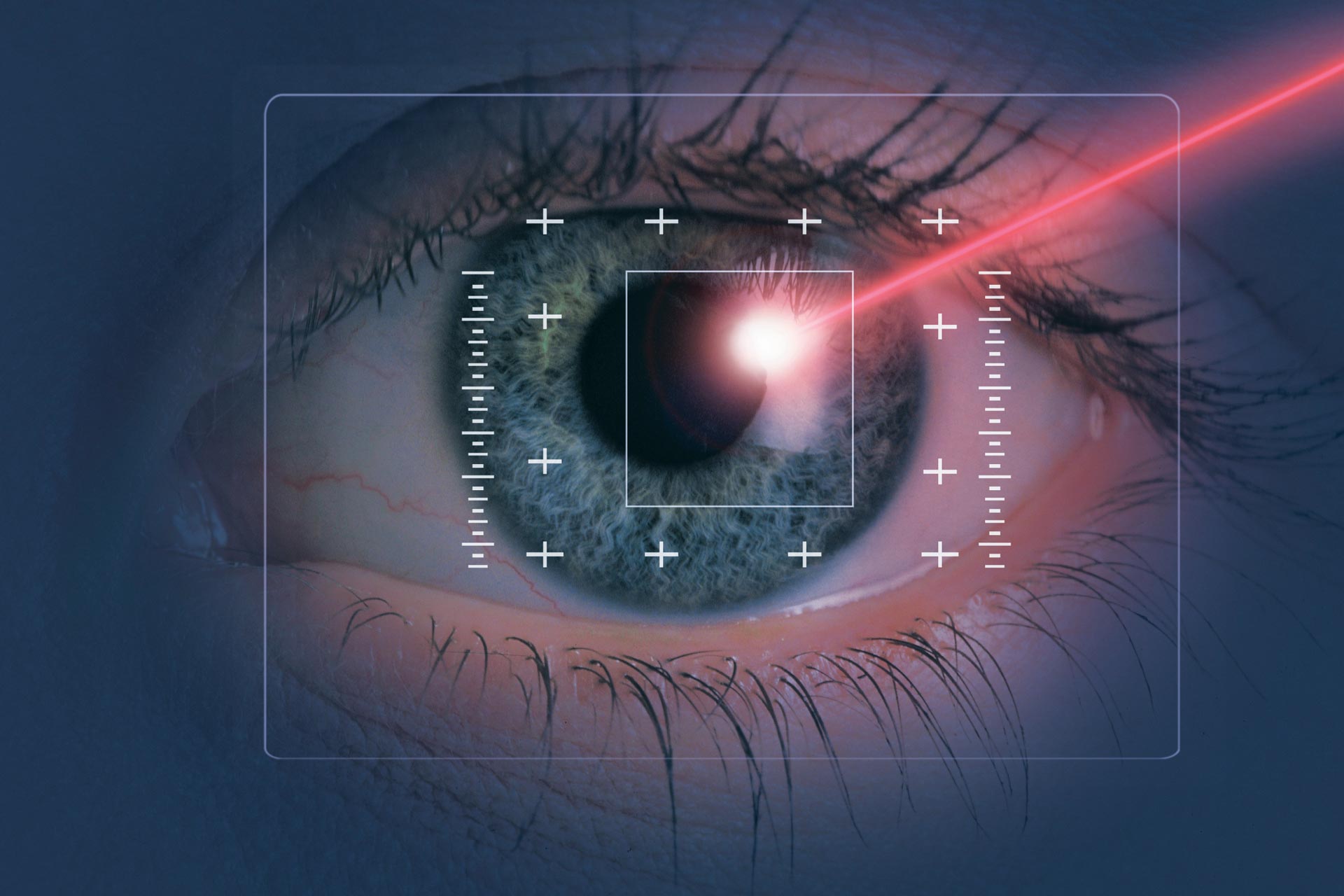 What is Laser Eye Surgery?