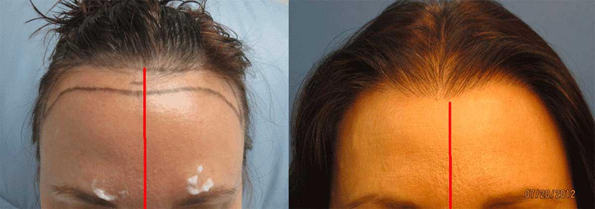 Can hair transplantation be performed on women as well?