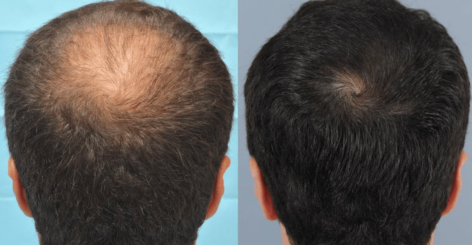 How can I prevent hair loss or thinning after a hair transplant procedure?