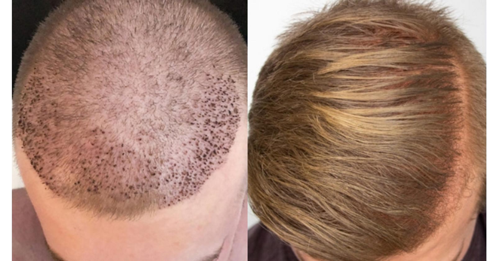 Can I dye, cut, or style my hair after a hair transplant procedure?