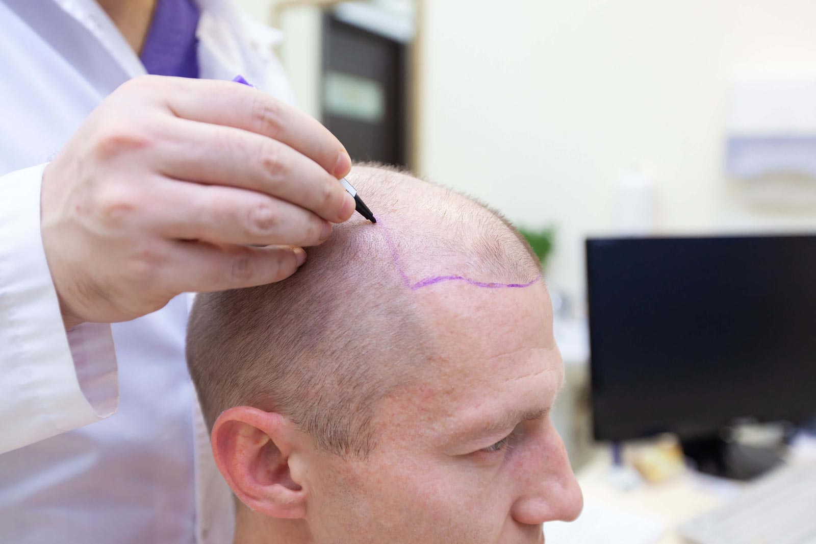 How long does it take to see the results of a hair transplant procedure?