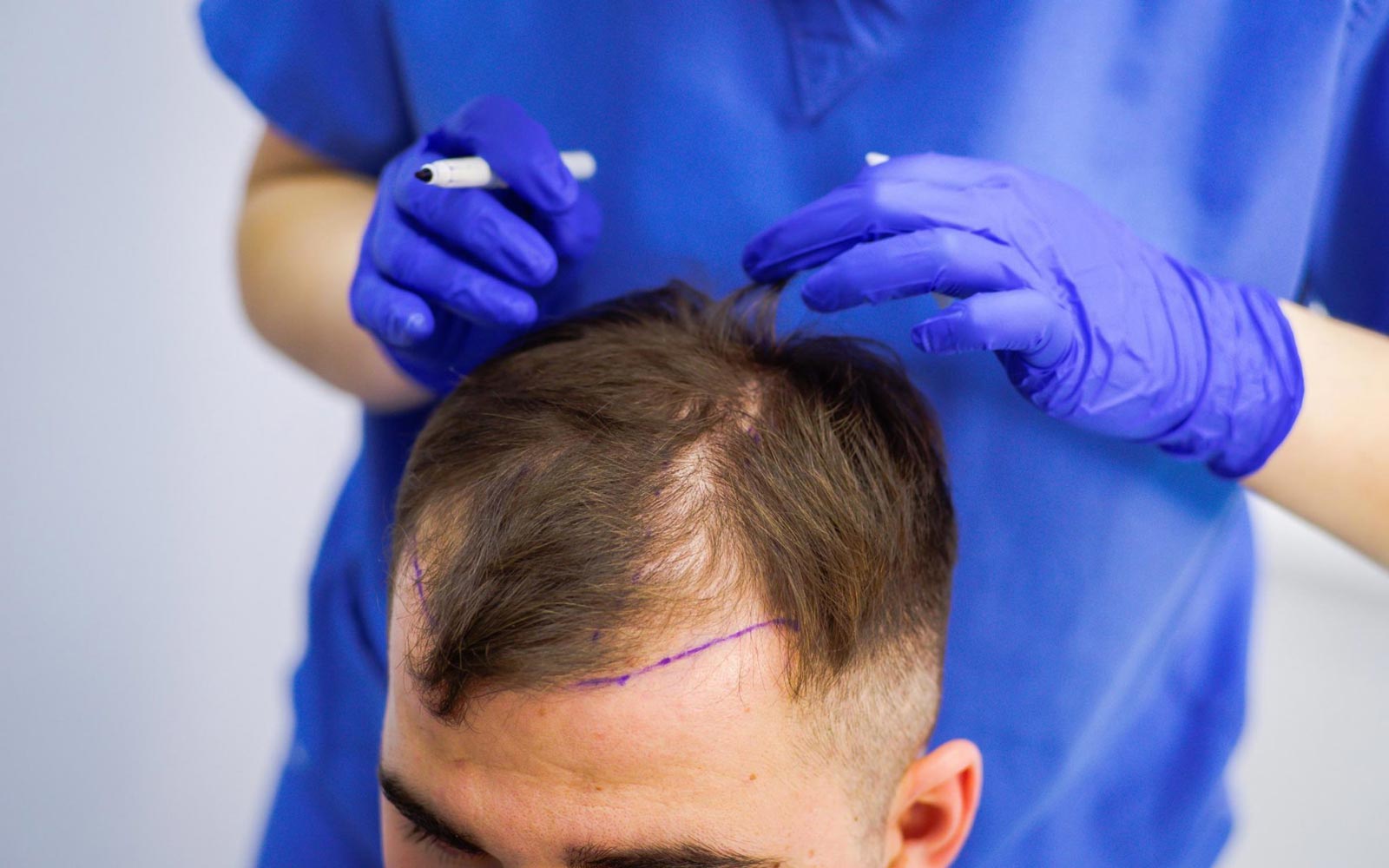 Who is a Good Candidate for Hair Transplant and Who is Not?