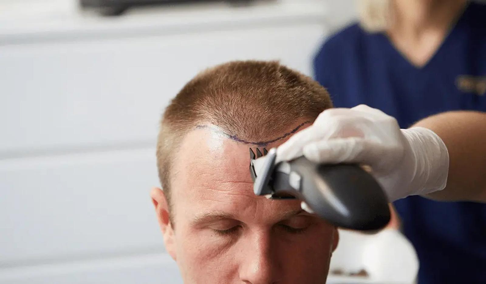 What is Hair Transplant and How is it Performed?