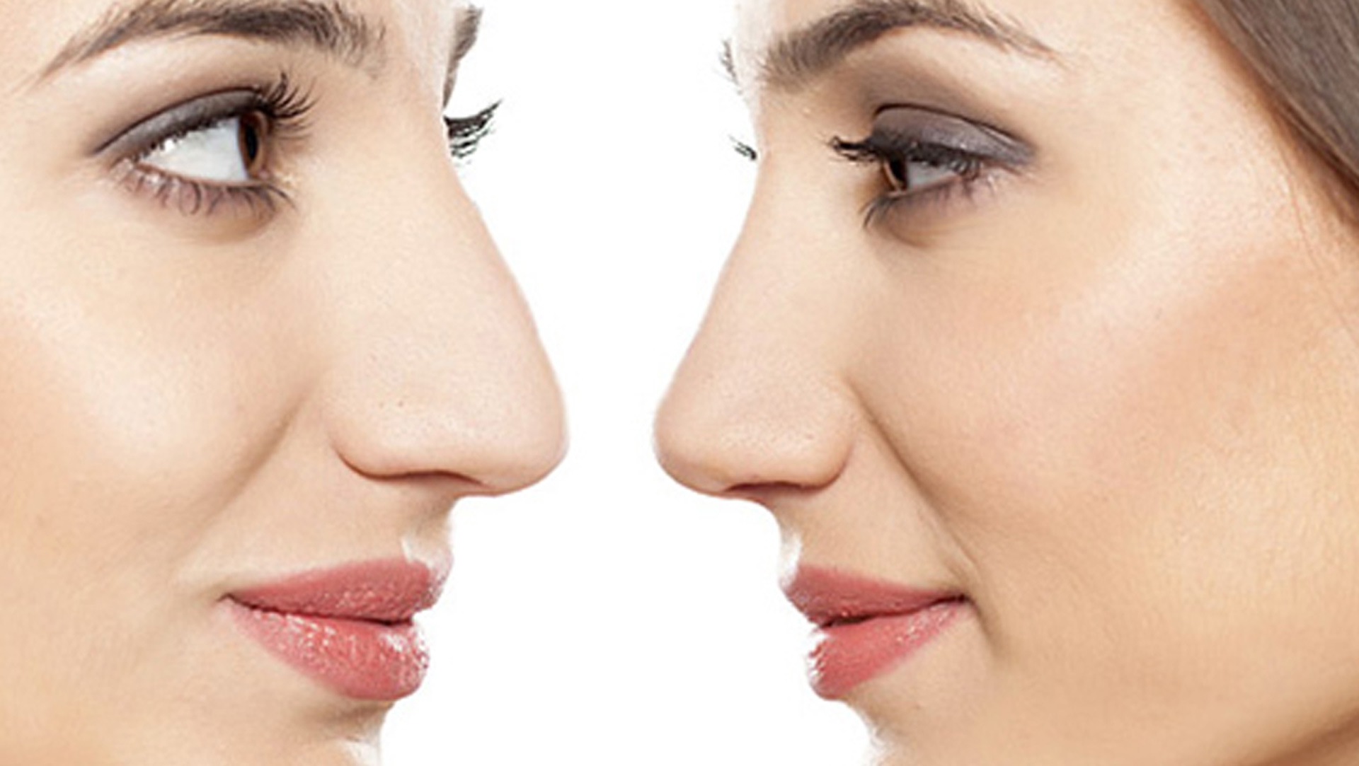 How long does it take to recover from a nose job?