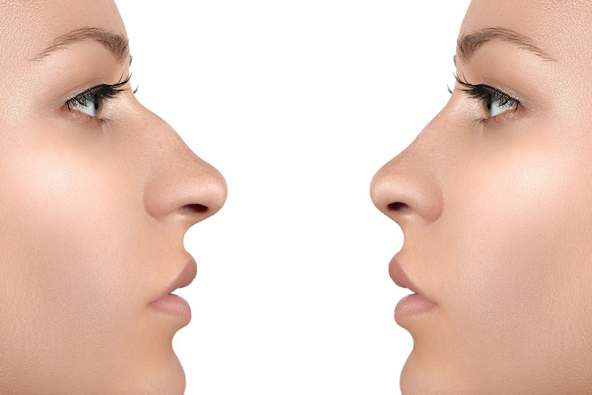 What to Expect During and After a Nose Job