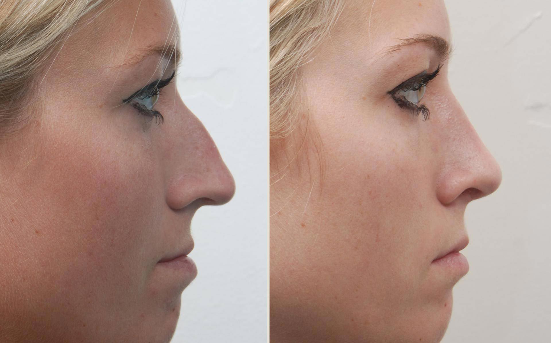 Different Types of Nose Job Techniques