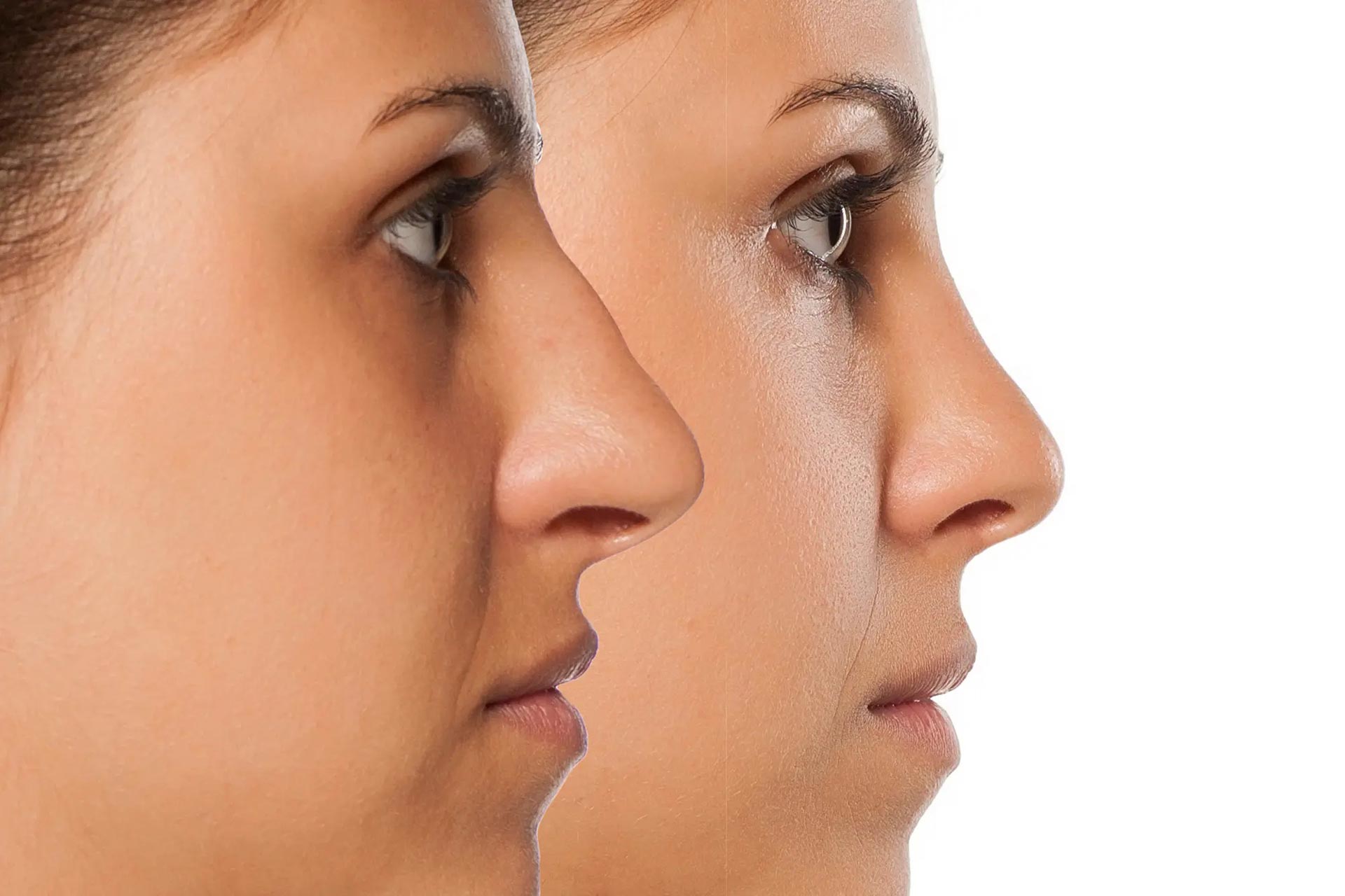 Benefits and Risks of a Nose Job