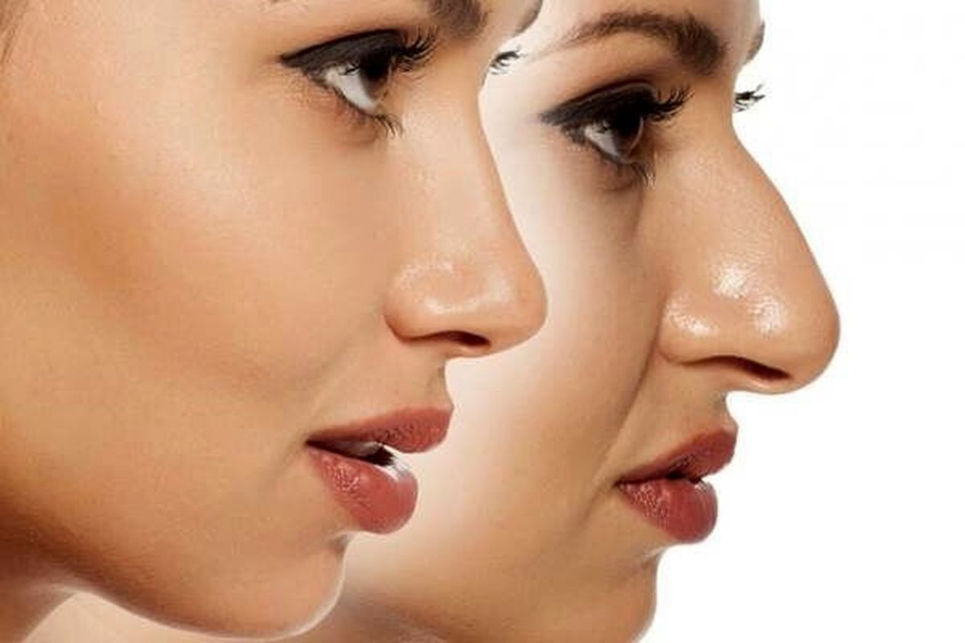 Results of Nose Job