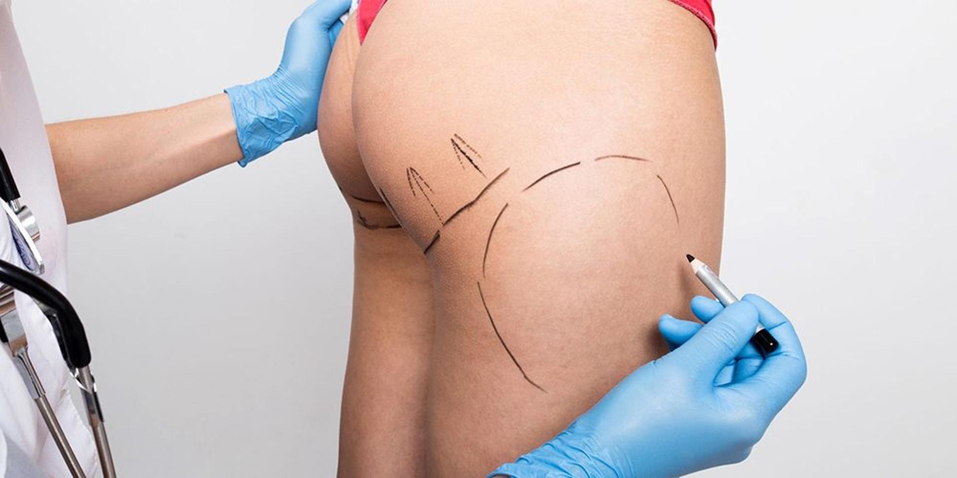 BBL surgery is popular among people who want to enhance their buttocks and body shape