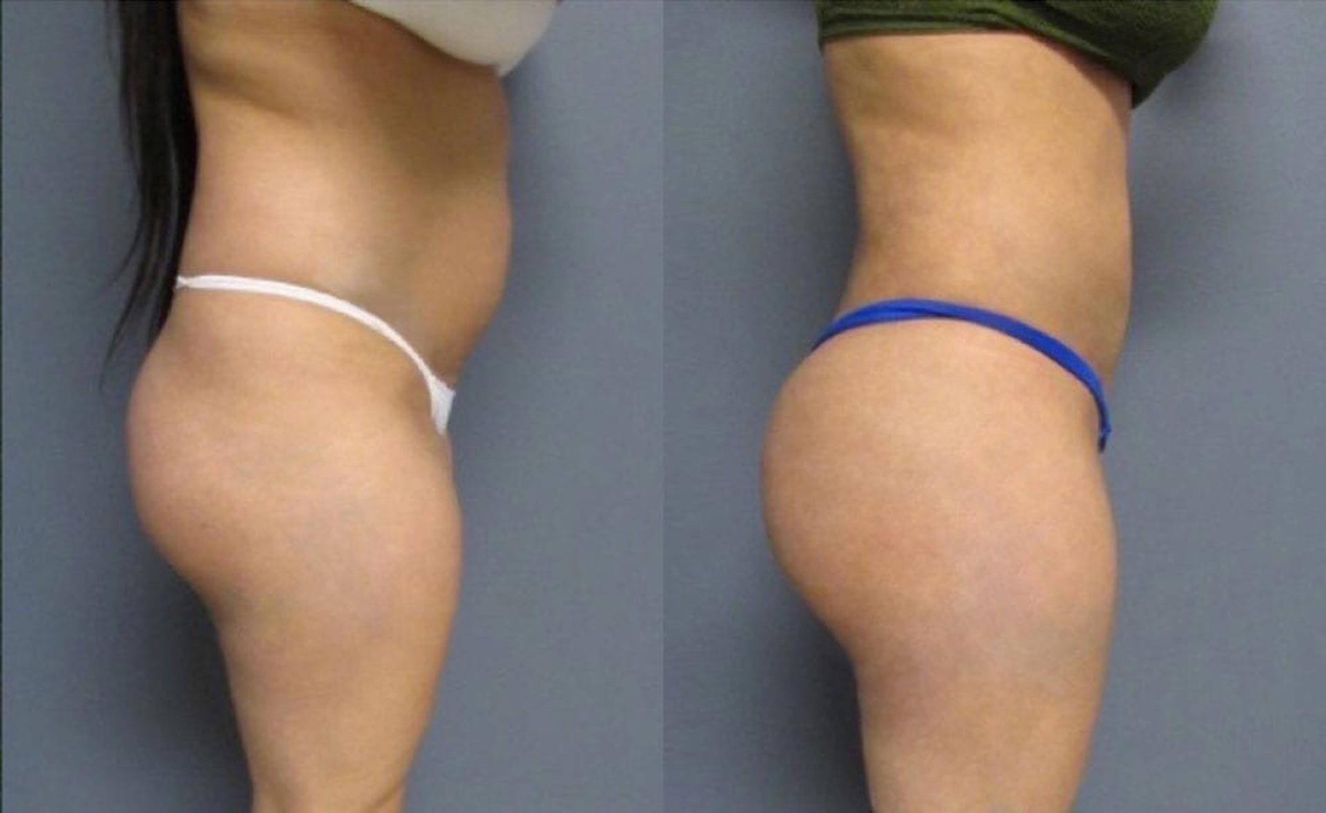 BBL surgery, or Brazilian Butt Lift