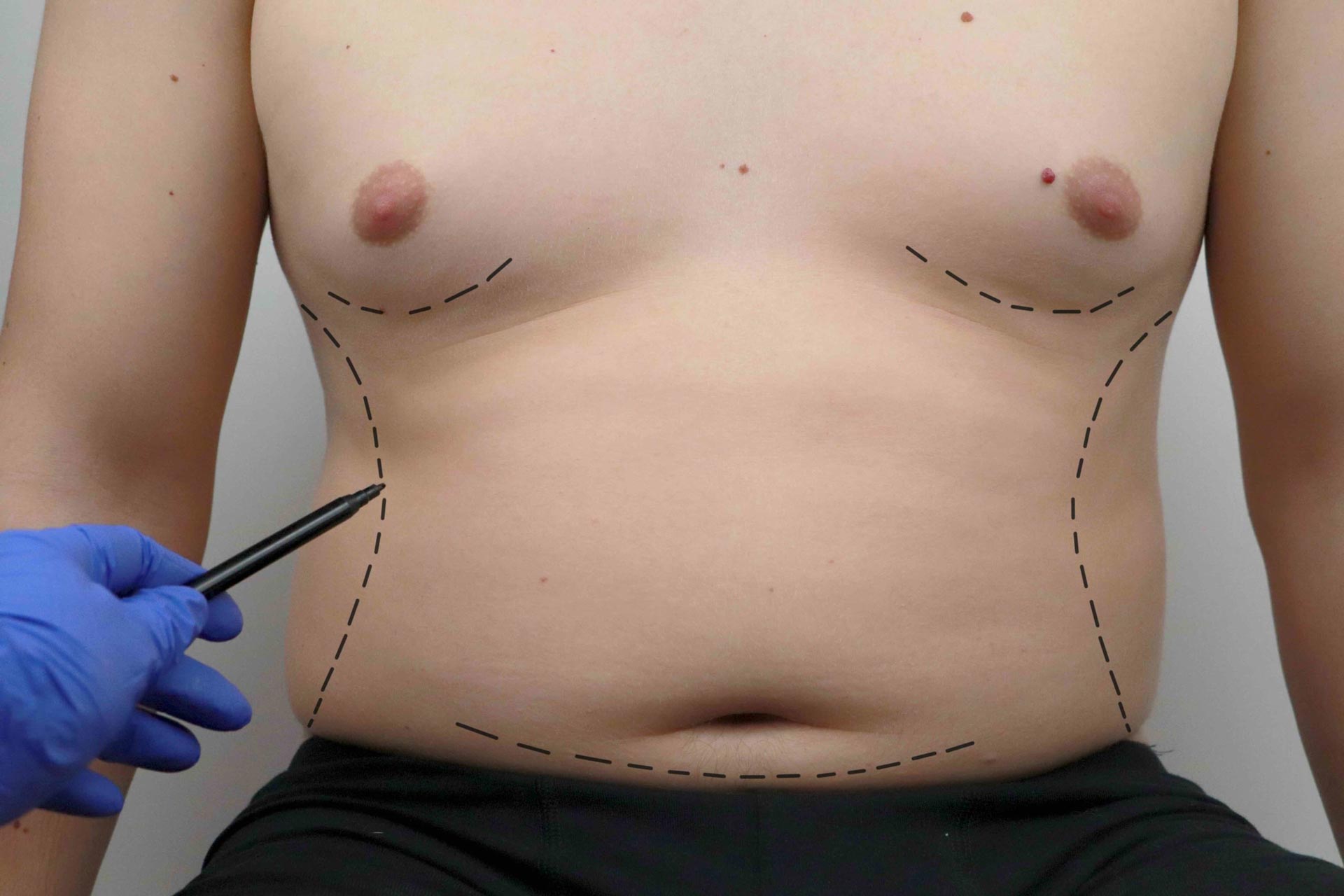 What is Liposuction and How Does It Work?