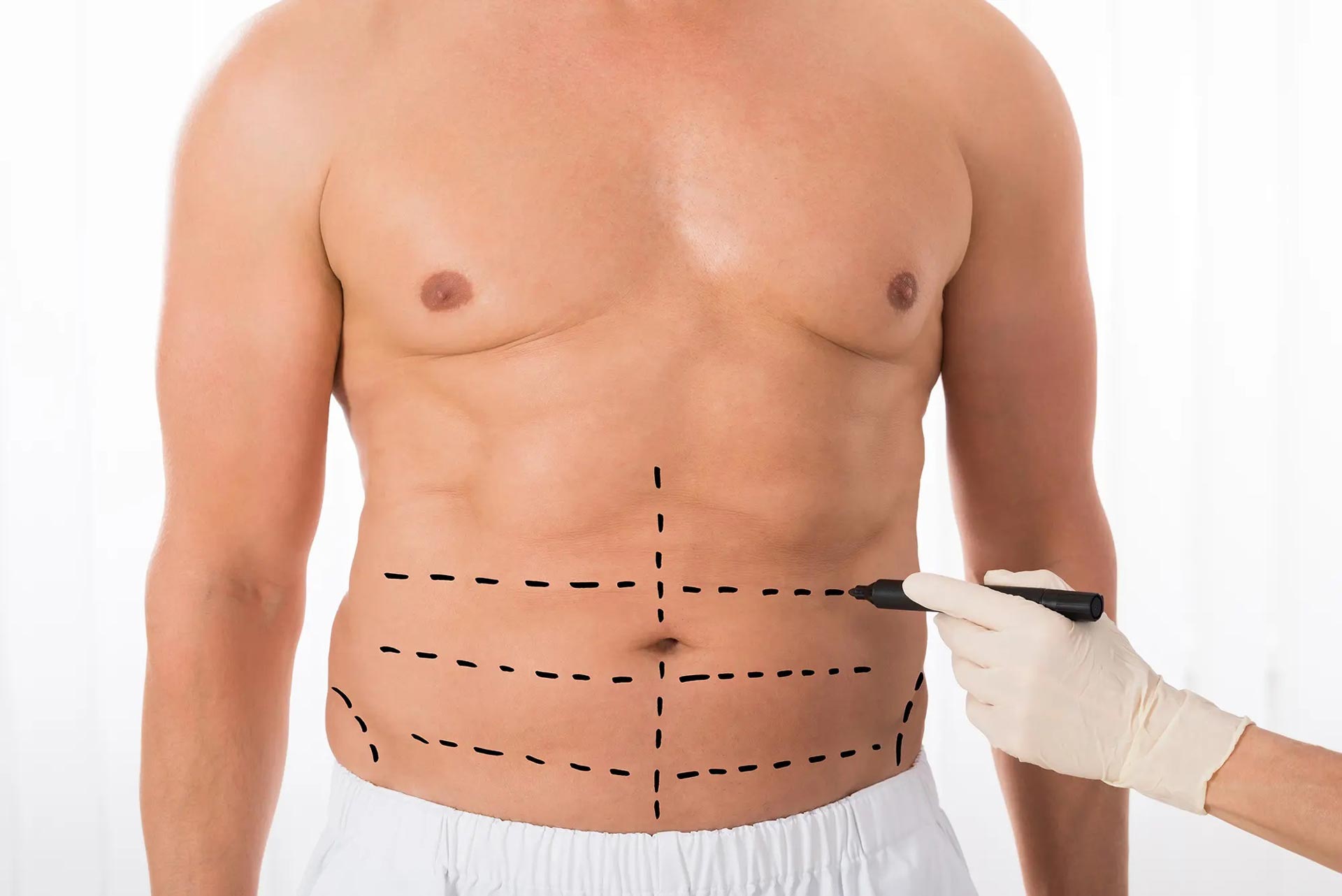 Q: How to find the best liposuction surgeon for men?