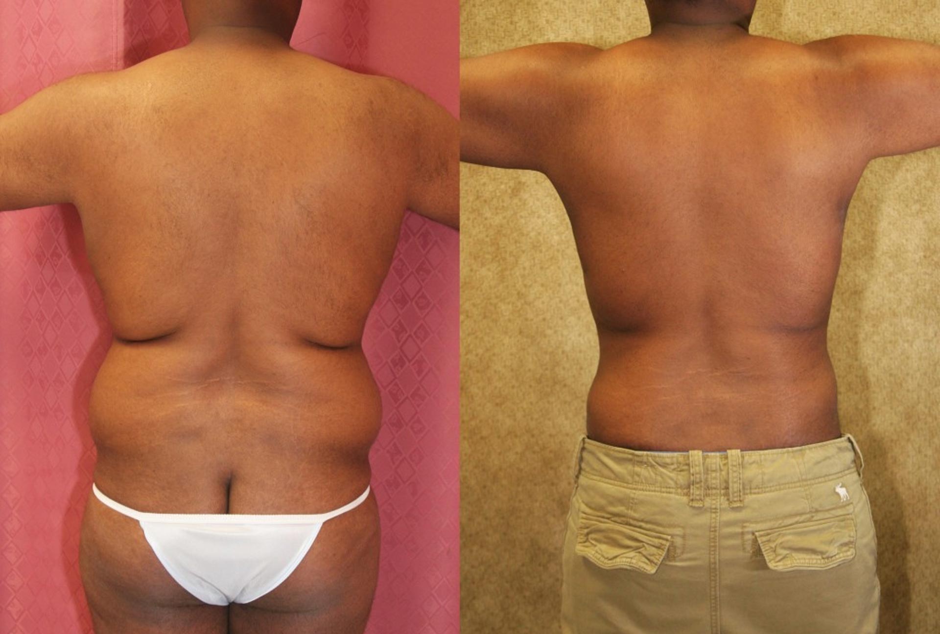 The expectations and goals of liposuction in men vary from person to person, but generally, they include: