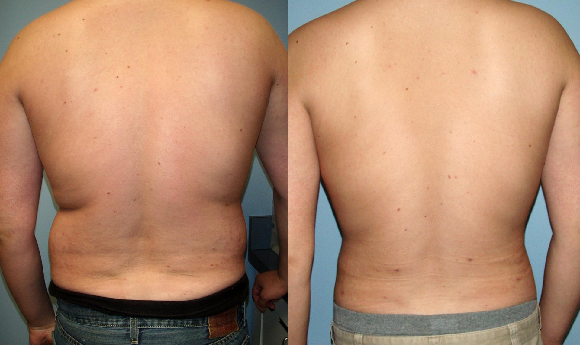 Why Do Men Choose Liposuction?