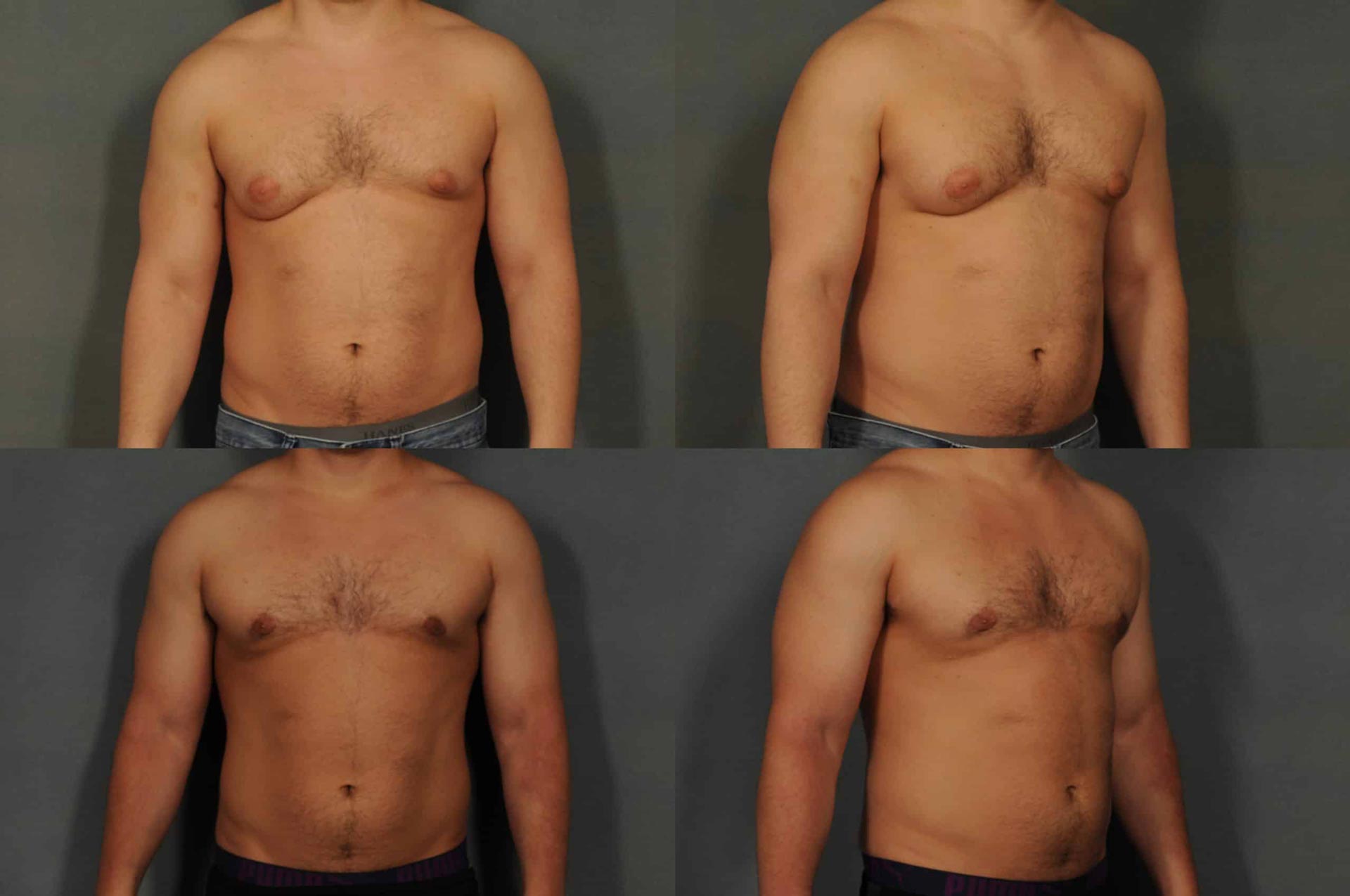 The benefits of liposuction for men include: