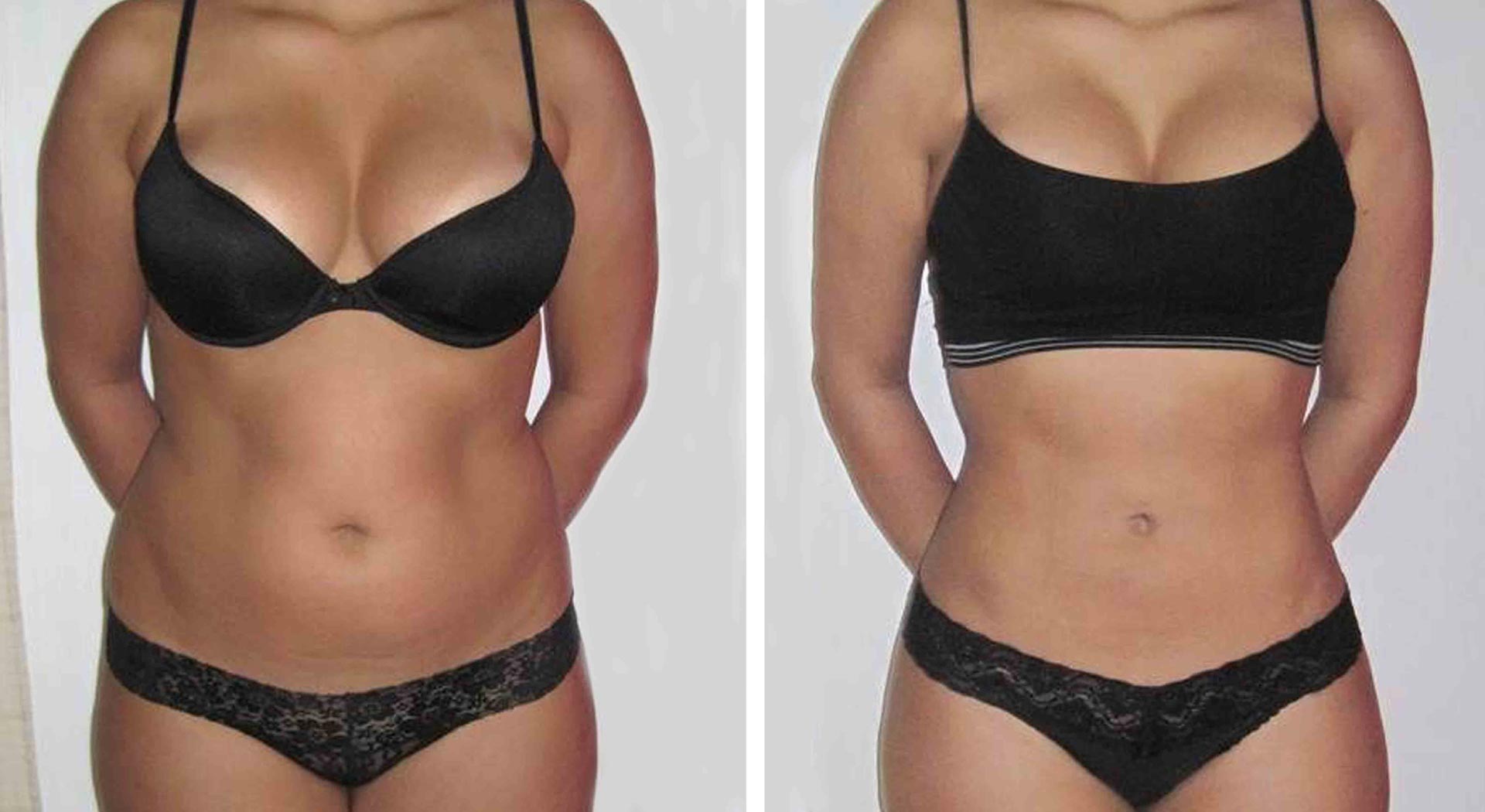 Liposuction is a cosmetic surgery that removes excess fat from specific areas of the body