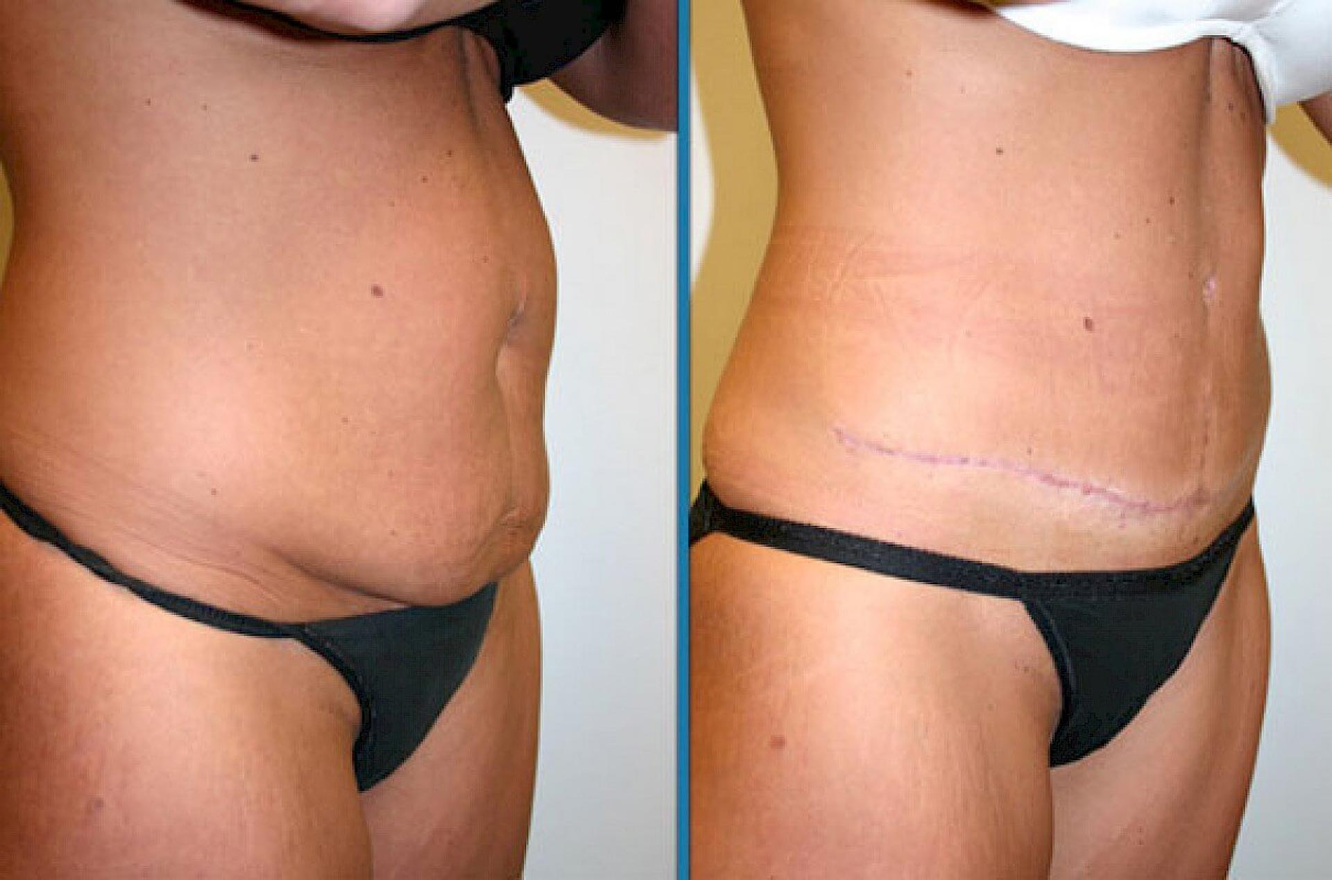 What are the benefits and risks of liposuction?