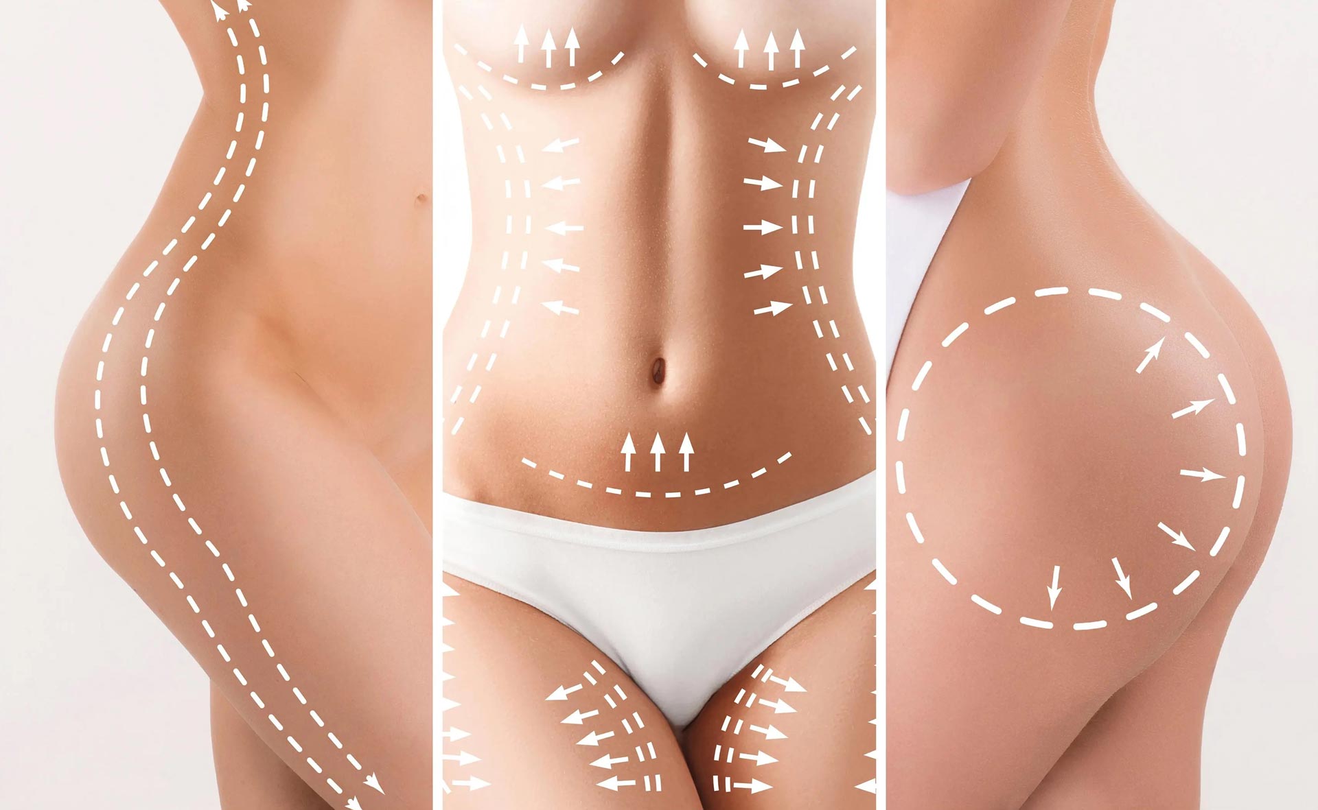 What is liposuction?