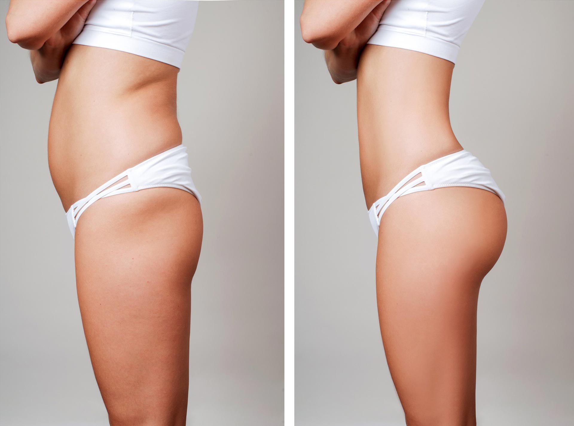 Liposuction in Turkey