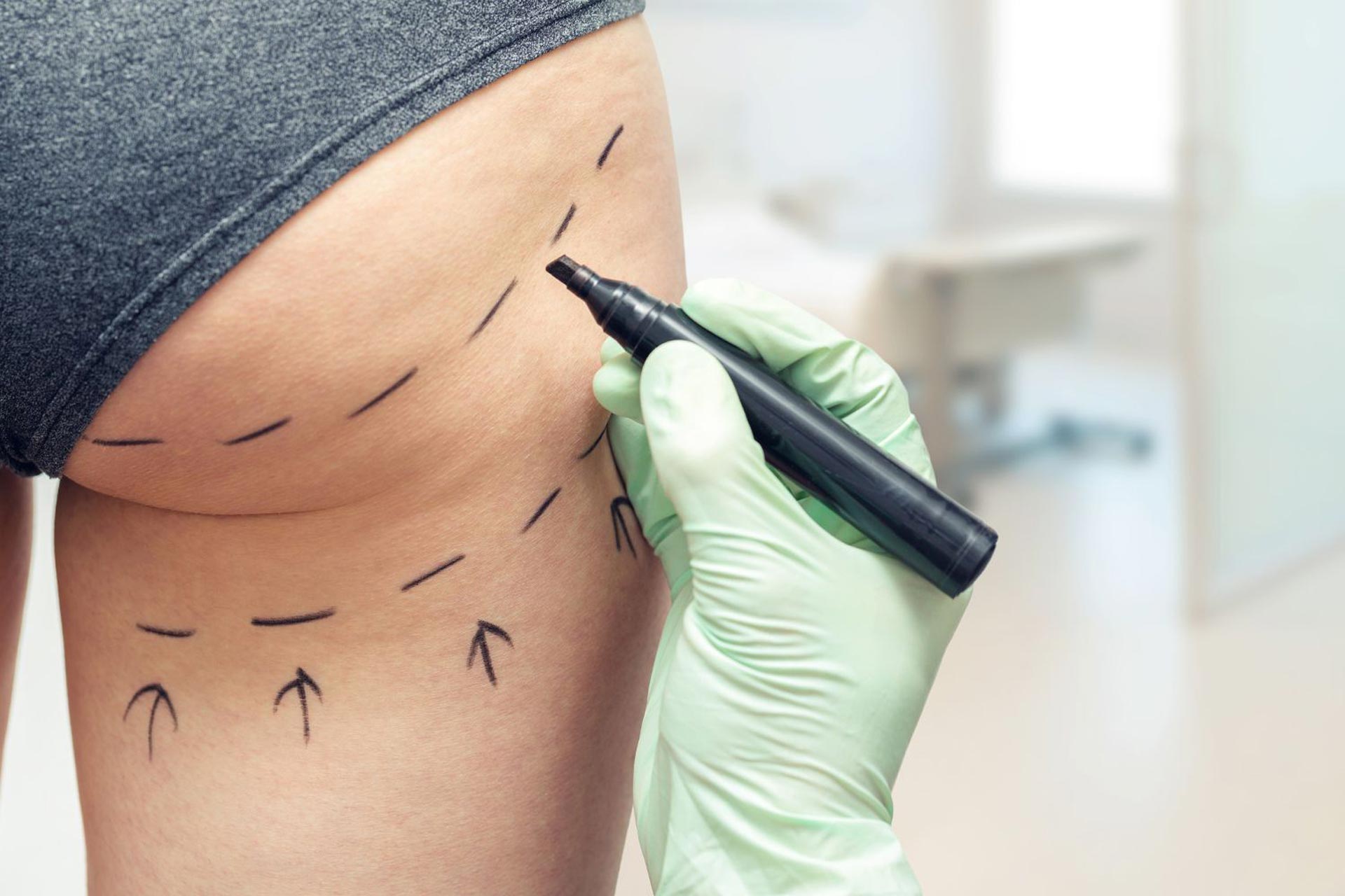 Q: How much does liposuction cost?