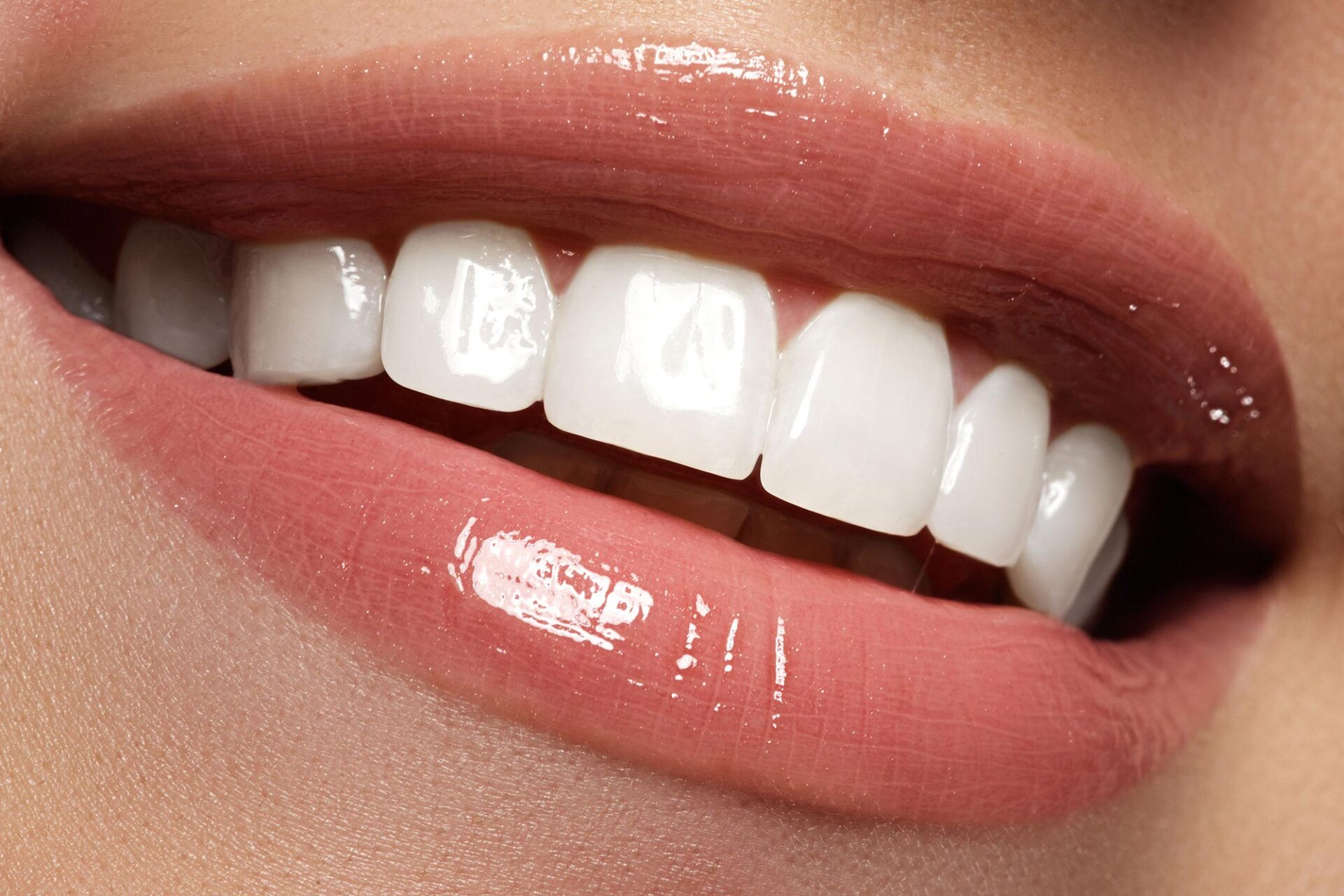 How can I find a good dentist for veneers?