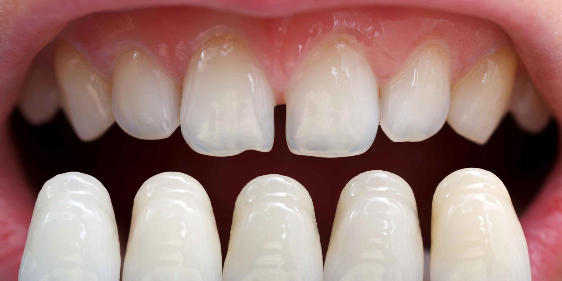 How do veneers compare to other cosmetic dental options?