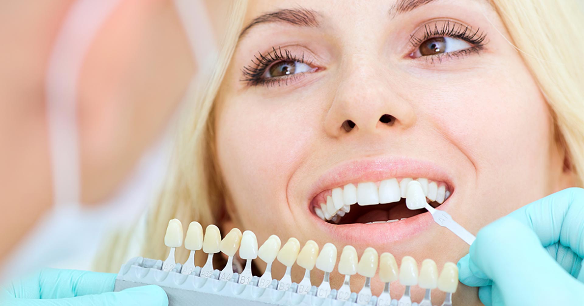 What are the Advantages of Veneers?